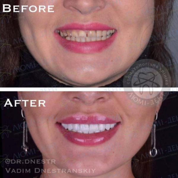 Усі сучасні способи вирівняти зуби: брекети, елайнери, вініри