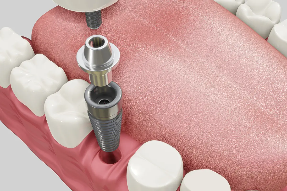 Абатмент