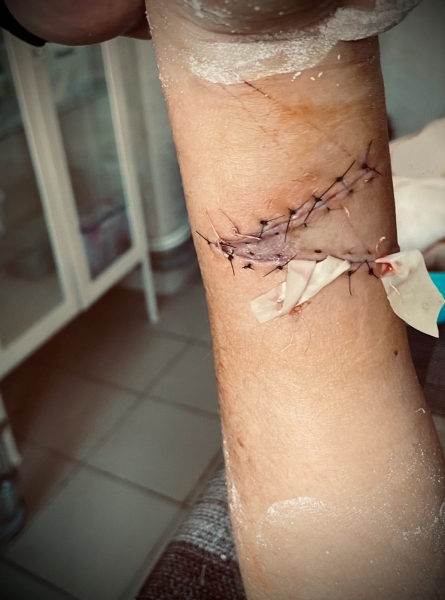 У Вінниці лікарі врятували сімнадцятирічній дівчині руку