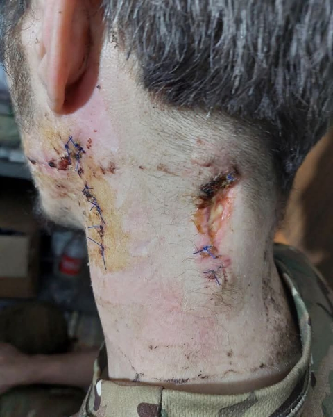 «Мене вбили на Азовсталі»: як «азовець» переміг смерть, росіян та полон