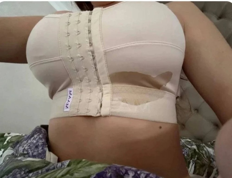 Підтяжка грудей обернулася важкими ускладненнями: франківська блогерка-мільйонниця поскаржилася на пережите (ФОТО)