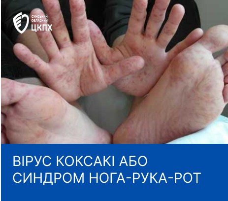 Вірус Коксакі: що мають знати про нього сум&rsquo;яни, аби не зіпсувати собі літній відпочинок