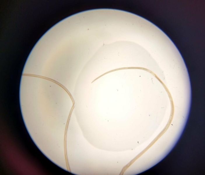 У Запоріжжі виявили зараження паразитом після укусу комара: черв&rsquo;яка витягли з повіки пацієнта