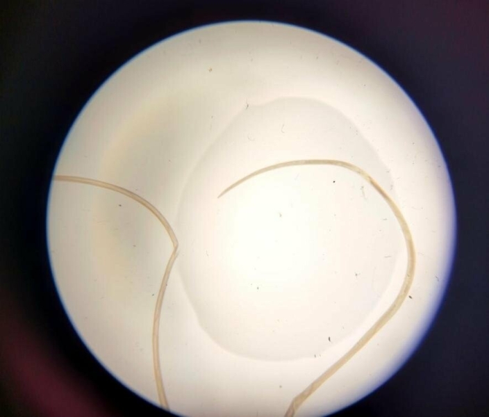 У Запоріжжі виявили зараження паразитом після укусу комара: черв&rsquo;яка витягли з повіки пацієнта