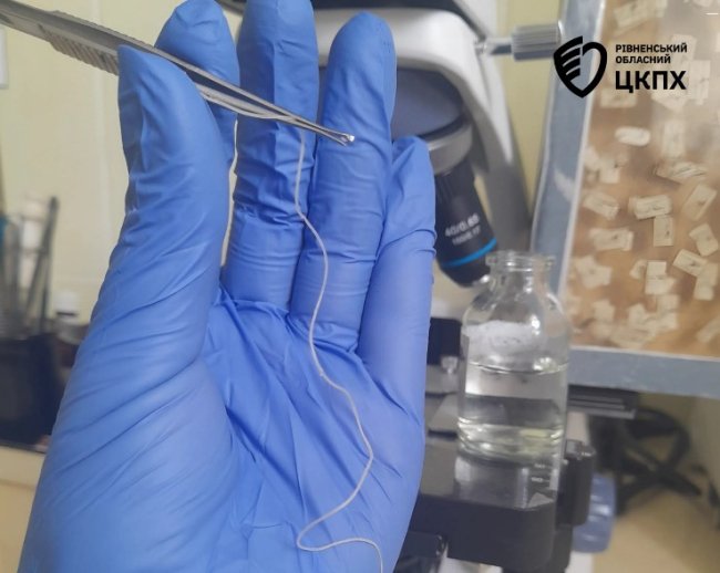 З ока жінки з Сарненщини дістали 11-сантиметрового паразита