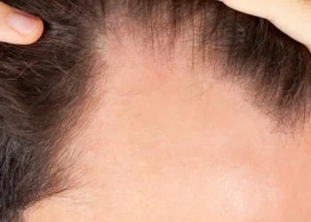 выпадение волос у мужчин