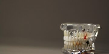 Вчені створили гель, який відновлює зубну емаль без фтору