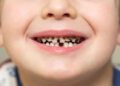 Кариес на молочных зубах