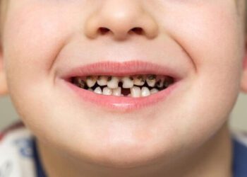 Кариес на молочных зубах