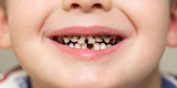 Кариес на молочных зубах