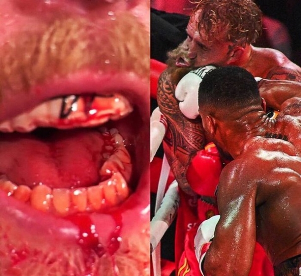 Нокаут Джошуа обернувся тяжкою травмою для Пола