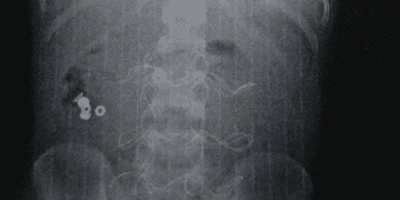 Дитина з Прикарпаття проковтнула батарейку, яка зруйнувала кишечник: що зараз із хлопчиком (ФОТО)