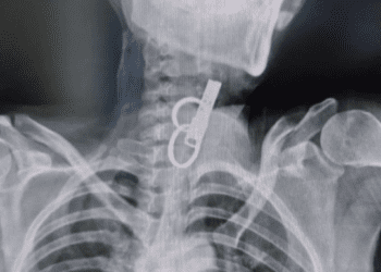 Без скальпеля і ризику: як на Тернопільщині врятували пацієнта, який проковтнув ключ (ФОТО)