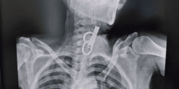 Без скальпеля і ризику: як на Тернопільщині врятували пацієнта, який проковтнув ключ (ФОТО)