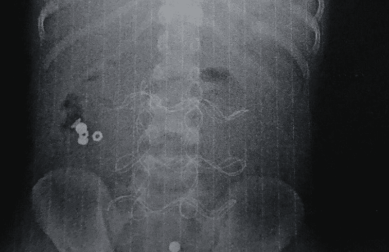 Дитина з Прикарпаття проковтнула батарейку, яка зруйнувала кишечник: що зараз із хлопчиком (ФОТО)