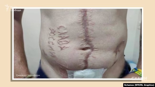 Журналісти ідентифікували російських хірургів, які катували українського полоненого у Донецьку і випалили напис &laquo;Слава России&raquo;