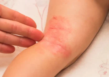 дерматит у дітей