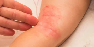 дерматит у дітей