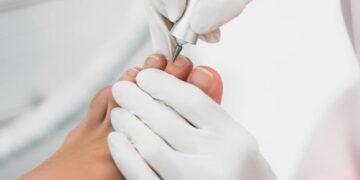 Медичний апаратний педикюр та врослий ніготь: чому подолог — це не майстер манікюру