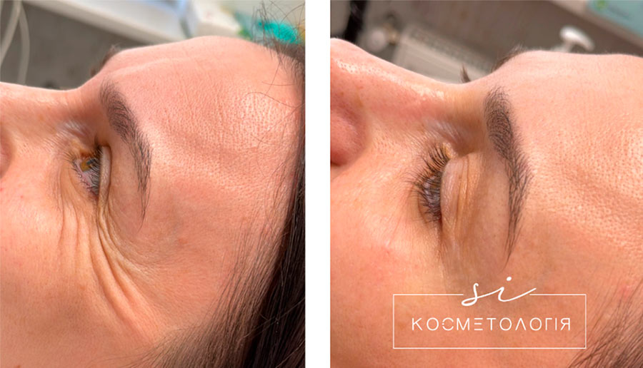 чистка обличчя у львові 