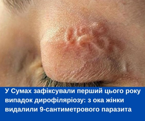 У Сумах зафіксували перший цього року випадок дирофіляріозу
